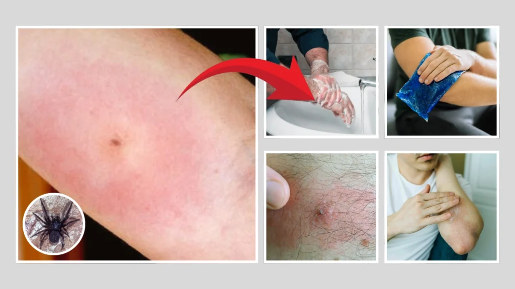 First Aid for a Black House Spider Bite