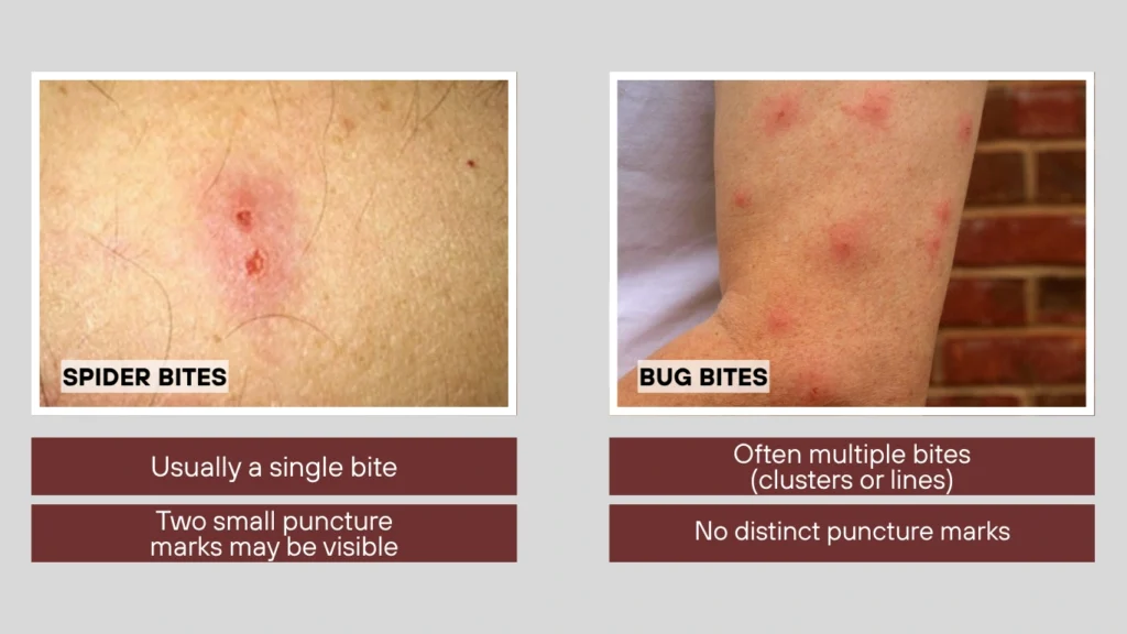 Key Differences Between Spider Bites and Bug Bites