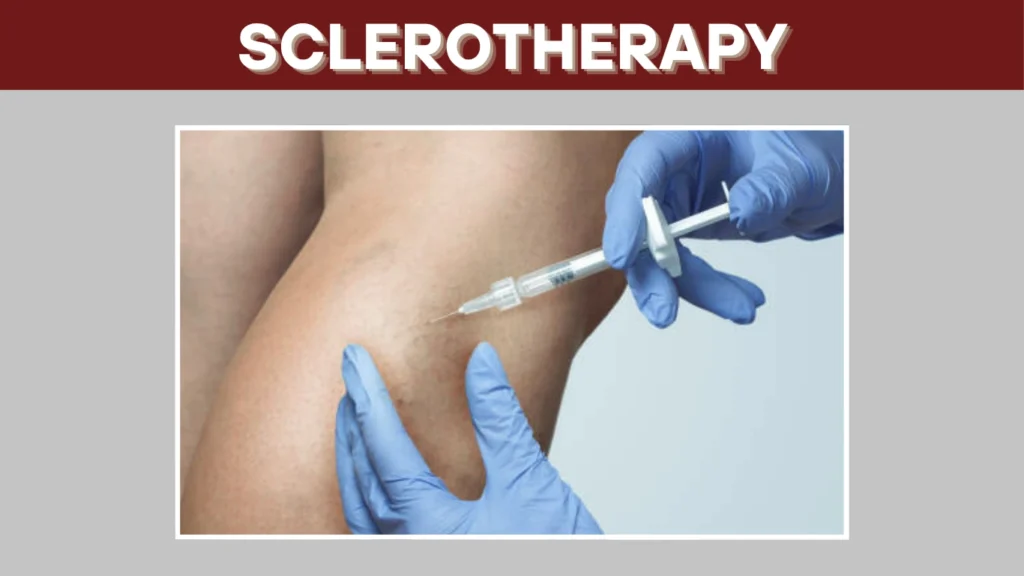 Sclerotherapy The Most Common Treatment
