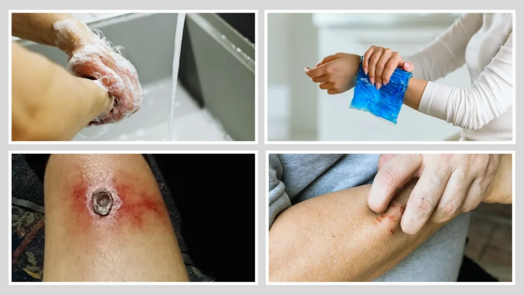 Brown Recluse Spiders Treatment and Recovery