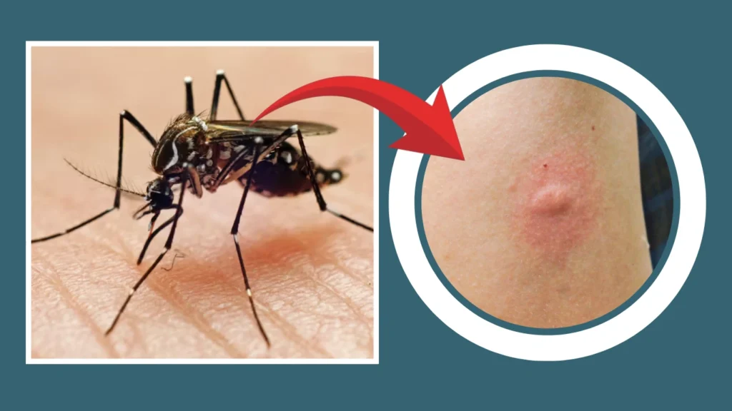 What Does a Mosquito Bite Look Like