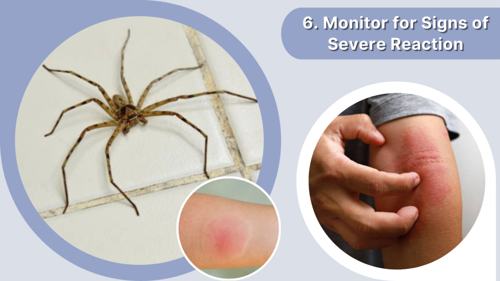 Spider Bite Treatment Monitor for Signs of Severe Reaction