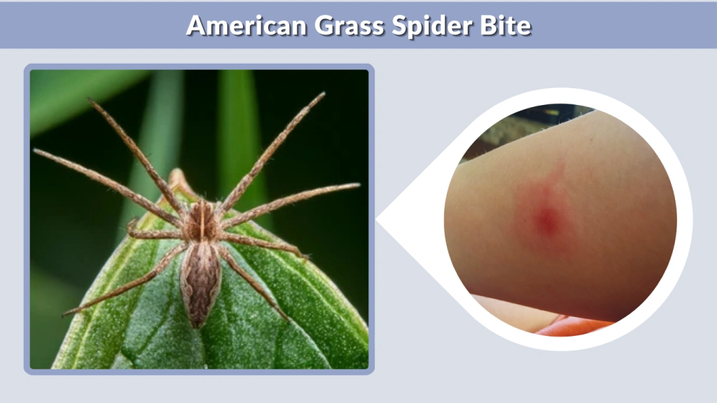 American Grass Spider Bite