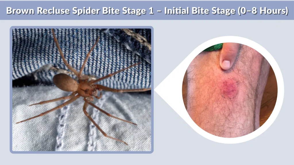 Brown Recluse Spider Bite Stage 1 – Initial Bite Stage (0–8 Hours)