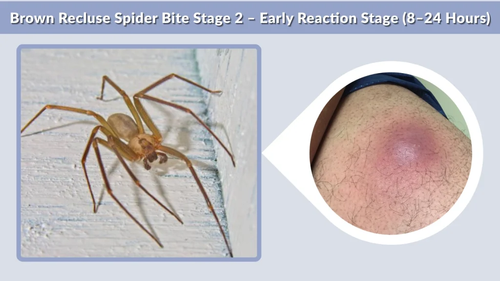 Brown Recluse Spider Bite Stage 2 – Early Reaction Stage (8–24 Hours)