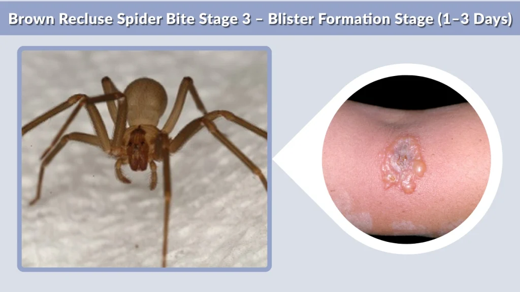 Brown Recluse Spider Bite Stage 3 – Blister Formation Stage (1–3 Days)