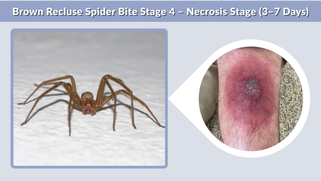 Brown Recluse Spider Bite Stage 4 – Necrosis Stage (3–7 Days)
