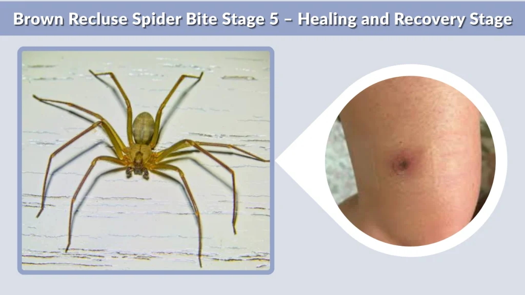 Brown Recluse Spider Bite Stage 5 – Healing and Recovery Stage