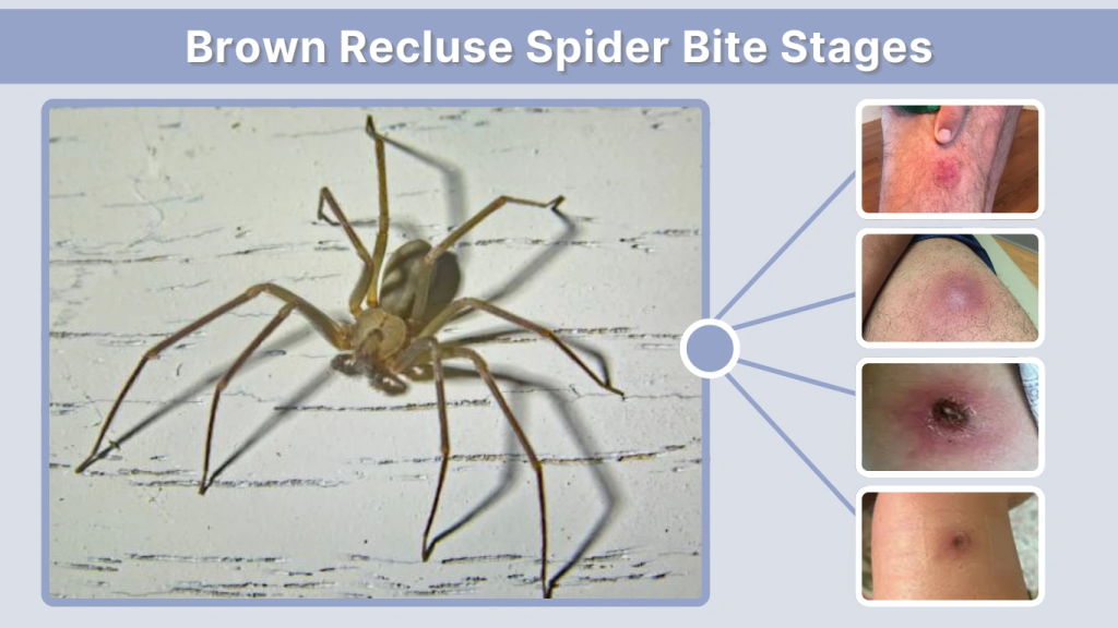 Brown Recluse Spider Bite Stages