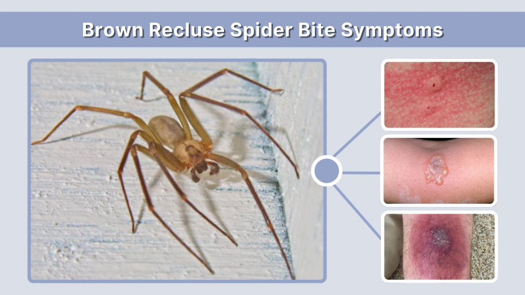 Brown Recluse Spider Bite Symptoms