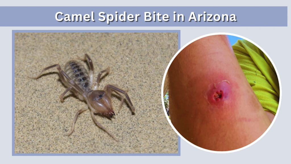 Camel Spider Bite in Arizona