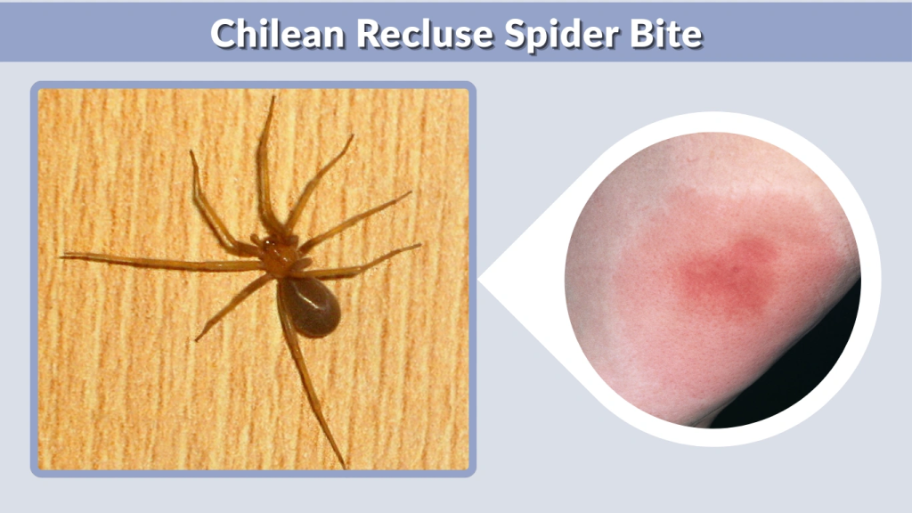 Chilean Recluse Spider Bite