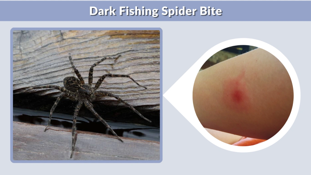 Dark Fishing Spider Bite