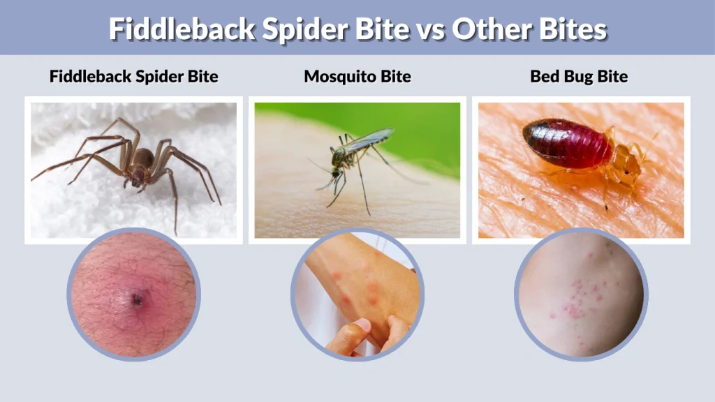 Fiddleback Spider Bite vs Other Bites