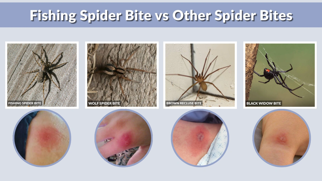 Fishing Spider Bite vs Other Spider Bites