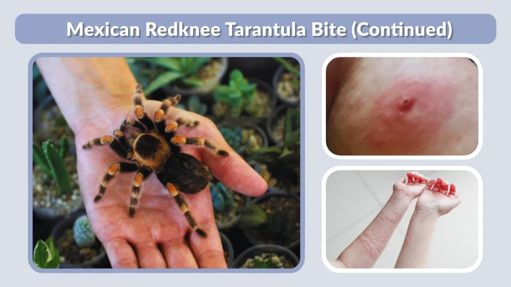 Mexican Redknee Tarantula Bite (Continued)