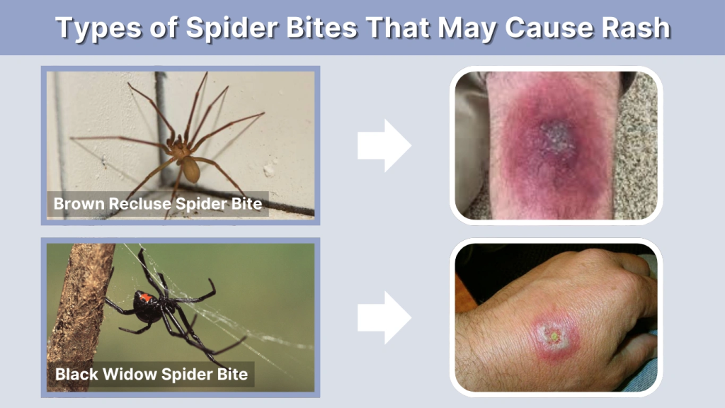 Types of Spider Bites That May Cause Rash