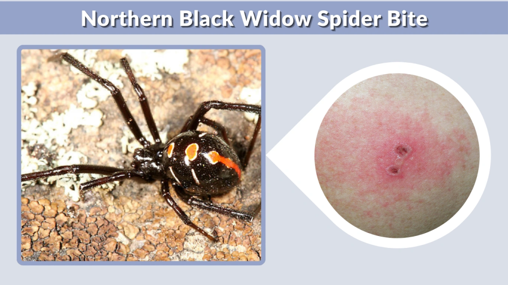 Northern Black Widow Spider Bite