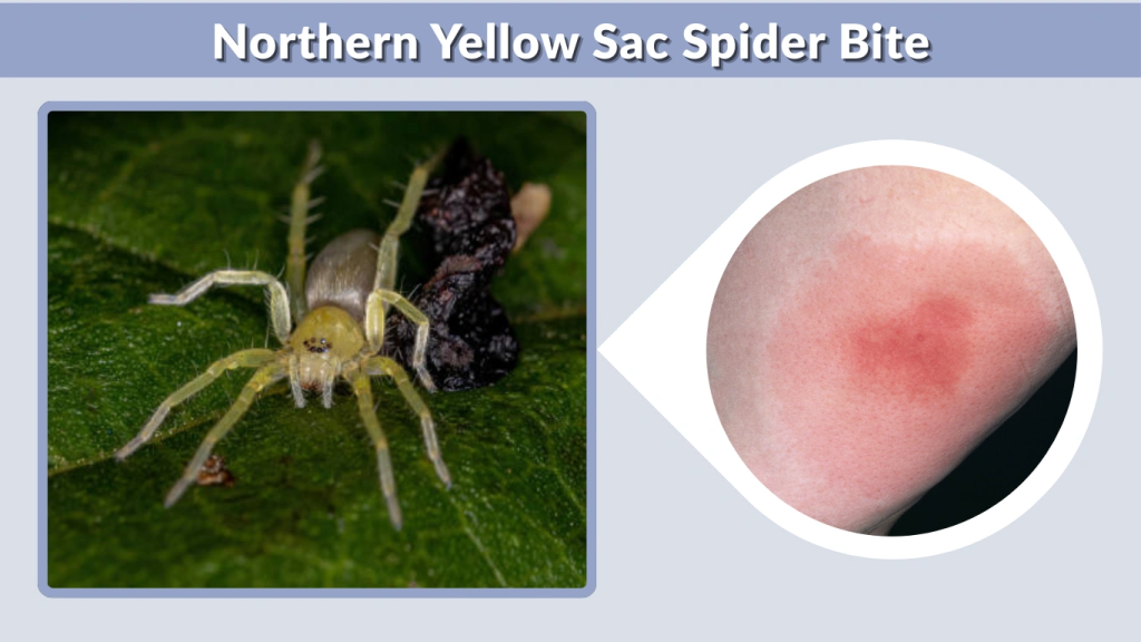 Northern Yellow Sac Spider Bite