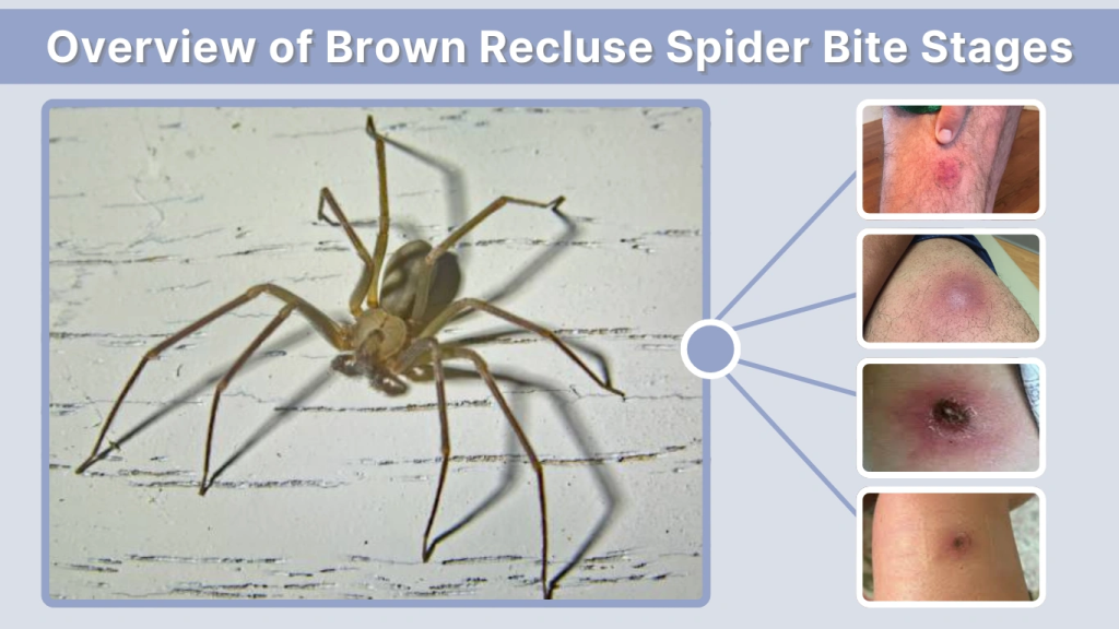 Overview of Brown Recluse Spider Bite Stages