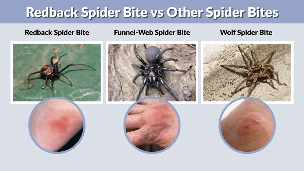 Redback Spider Bite vs Other Spider Bites