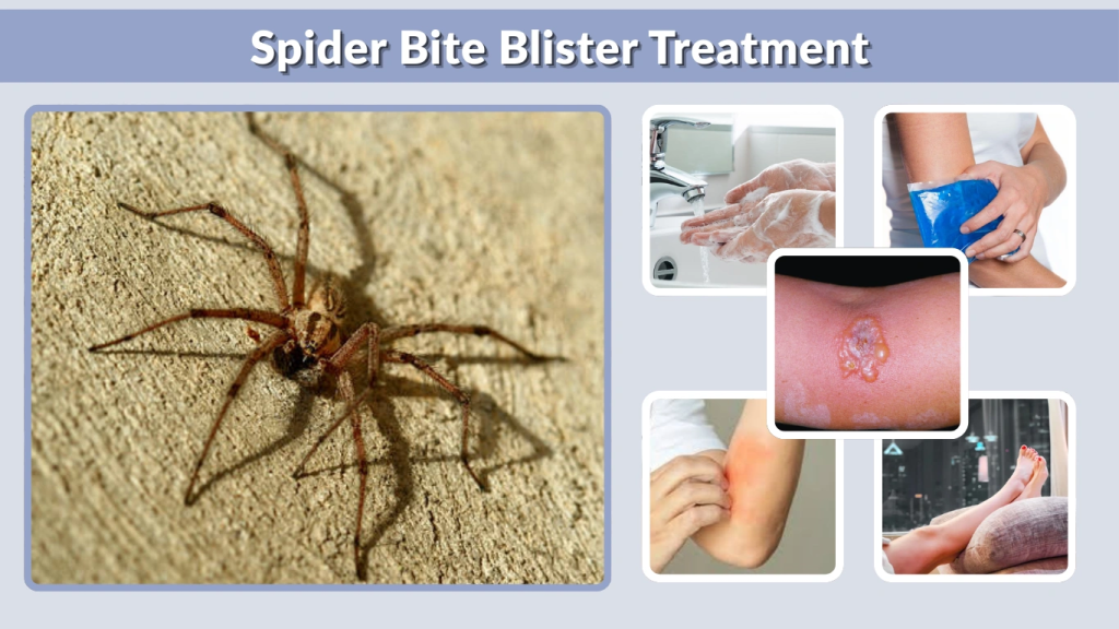 Spider Bite Blister Treatment