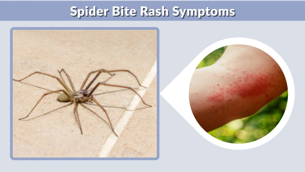 Spider Bite Rash Symptoms
