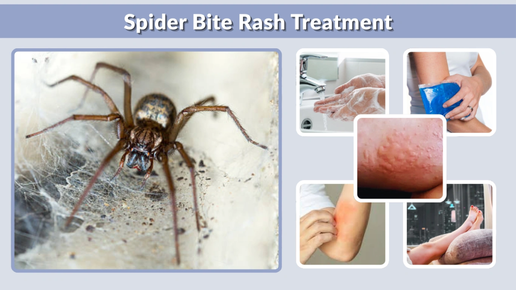 Spider Bite Rash Treatment