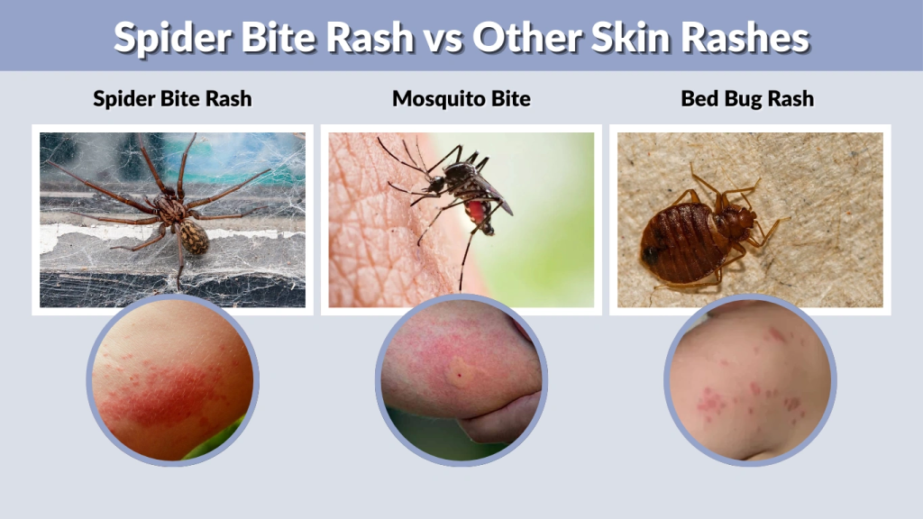 Spider Bite Rash vs Other Skin Rashes