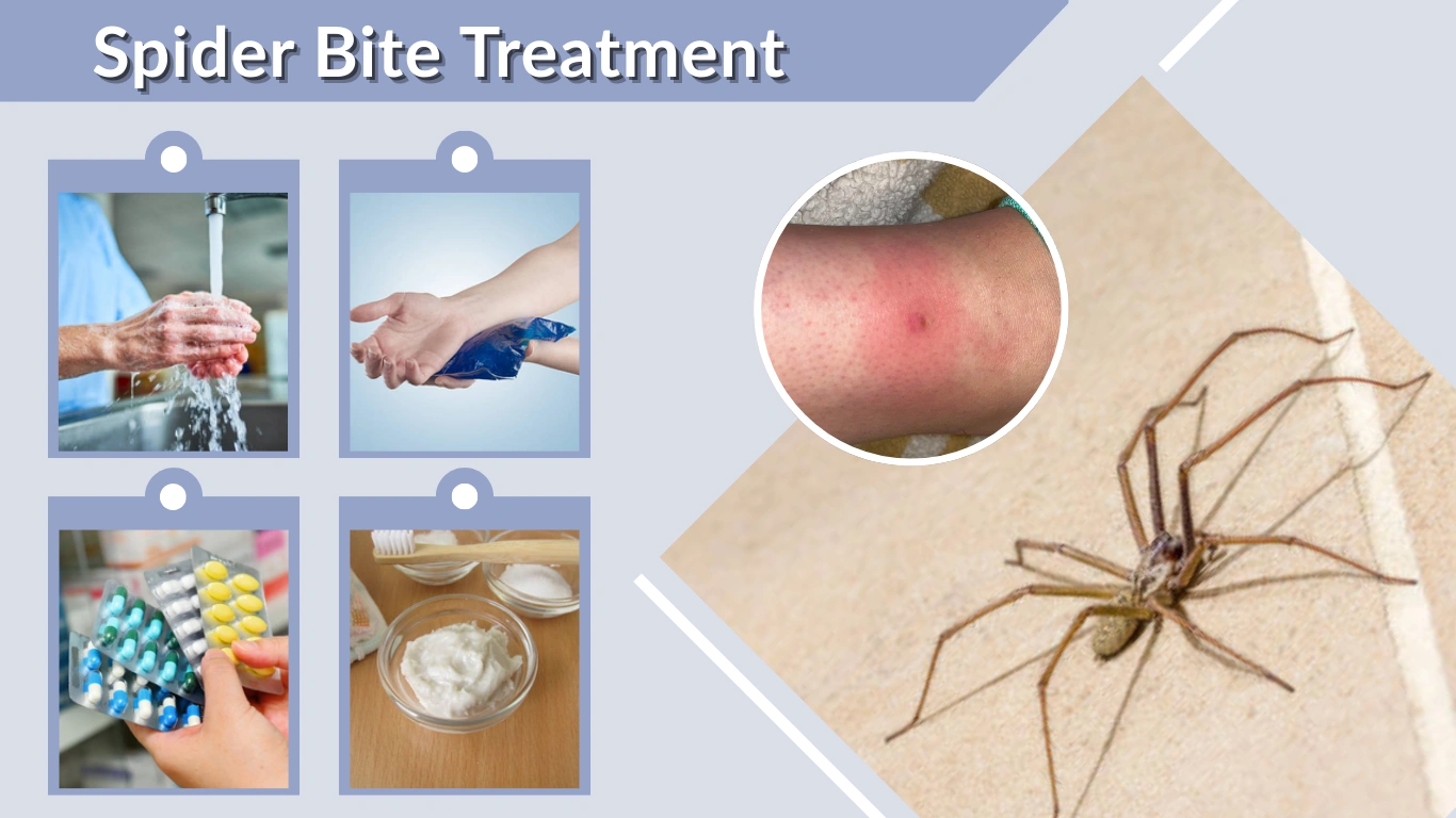 Spider Bite Treatment: 7 Best Ways to Heal Safely
