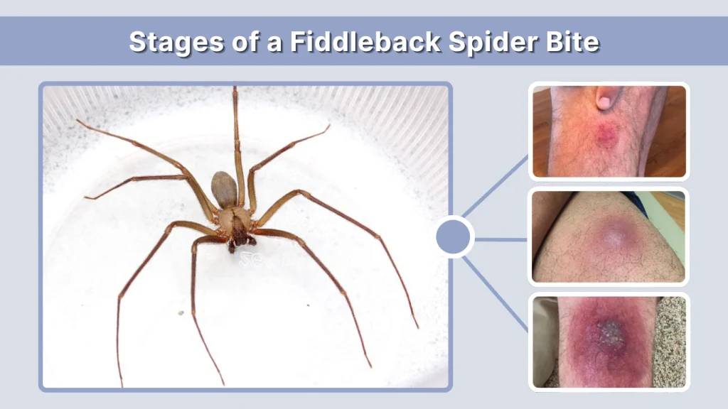 Stages of a Fiddleback Spider Bite