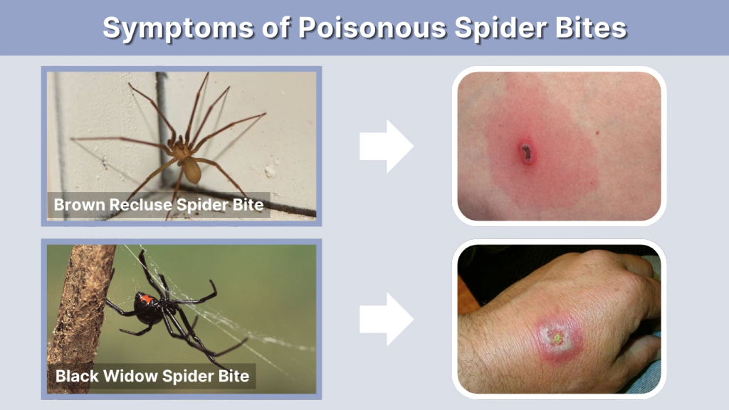 Symptoms of Poisonous Spider Bites