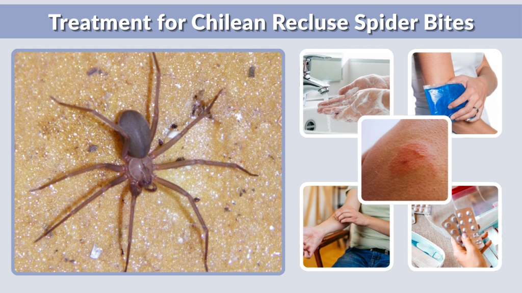Treatment for Chilean Recluse Spider Bites