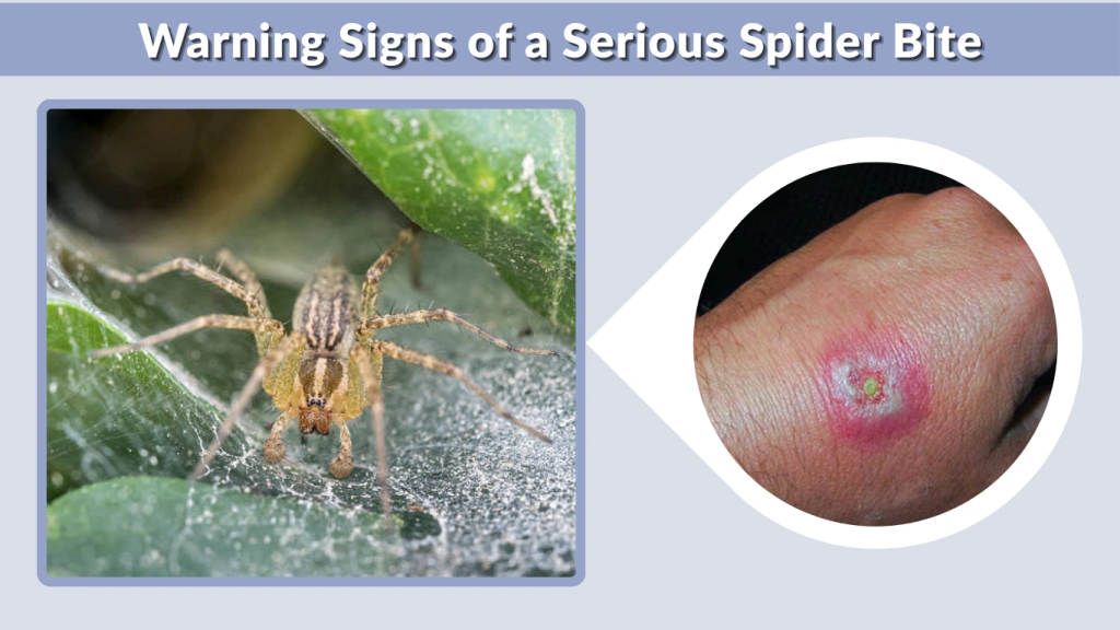 Warning Signs of a Serious Spider Bite