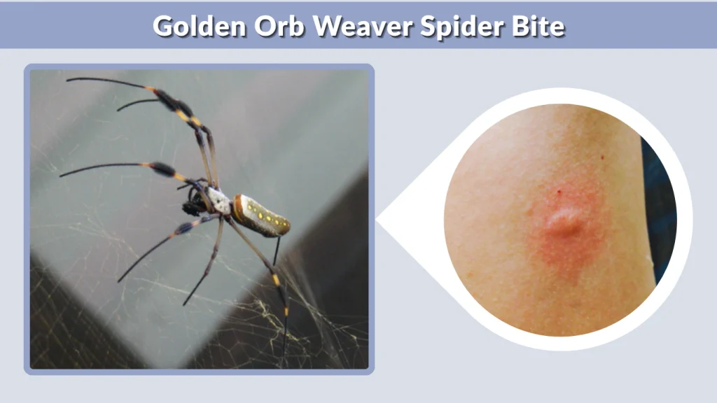 Golden Orb Weaver Spider Bite