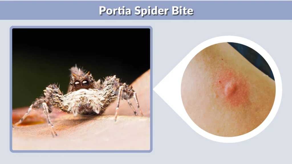 Portia Spider Bite