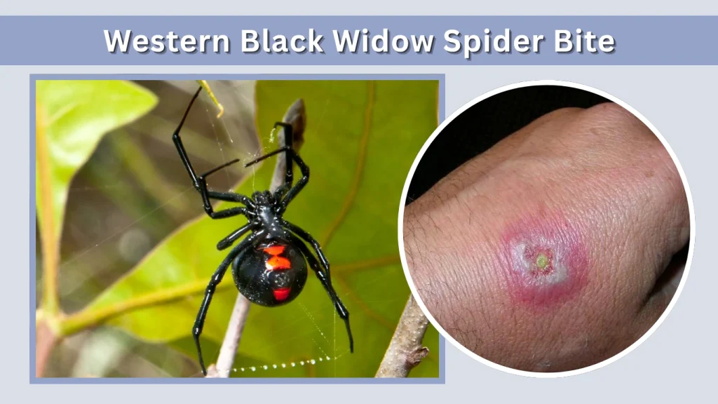 Western Black Widow Spider Bite