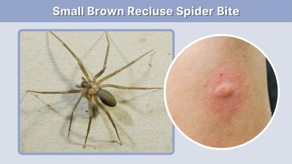 Small Brown Recluse Spider Bite