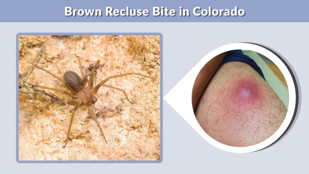 Brown Recluse Bite in Colorado