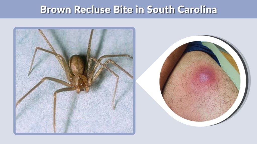 Brown Recluse Bite in South Carolina
